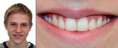 Nach Invisalign Behandlung 