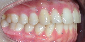 Patientenbeispiel Invisalign bei Judentlichen