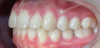 Patientenbeispiel Invisalign bei Kindern
