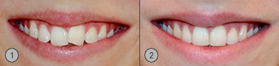 Vor und Nachher Bilder Invisalign Teen® Patientenbeispiel