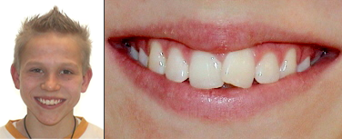 Vor Invisalign Behandlung 
