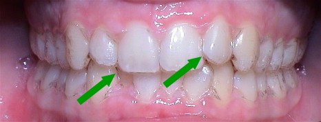 Ästhetische Vorteile durch Invisalign®