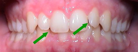 Vorteile Zahnästhetik Invisalign® Therapie