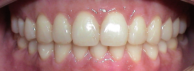 Nach  Invisalign® Progenie Therapie