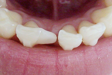 Patientenbeispiel Invisalign® Progenie Kunststoffschild