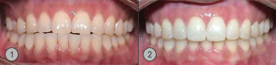Vor und Nachher Bilder Proganie Invisalign® Patientenbeispiel