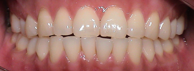 Vor Invisalign® Progenie Therapie