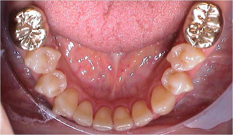Einzelzahnrotationen ohne feste Zahnspange